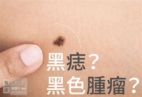 脖子長黑痣|皮膚長痣、長斑是皮膚癌前兆？皮膚癌初期4大症狀快。